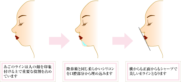 FBC式あごの美容形成術イメージ図
